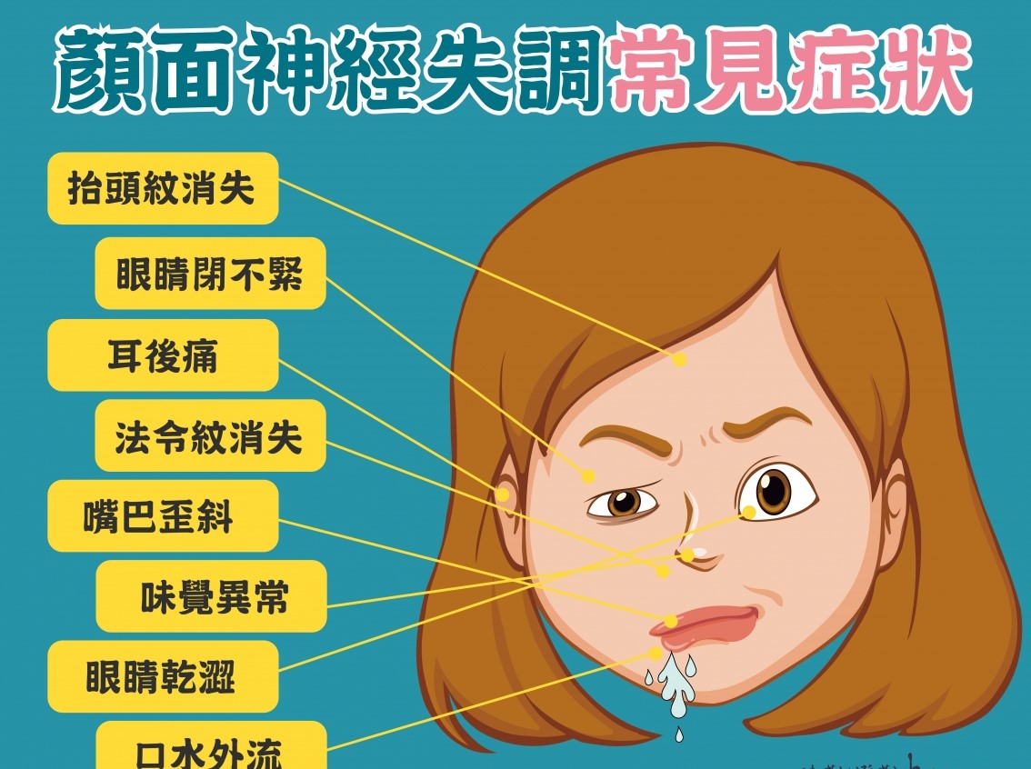 嘴歪臉斜不一定是中風！當心也可能是顏面神經麻痺！