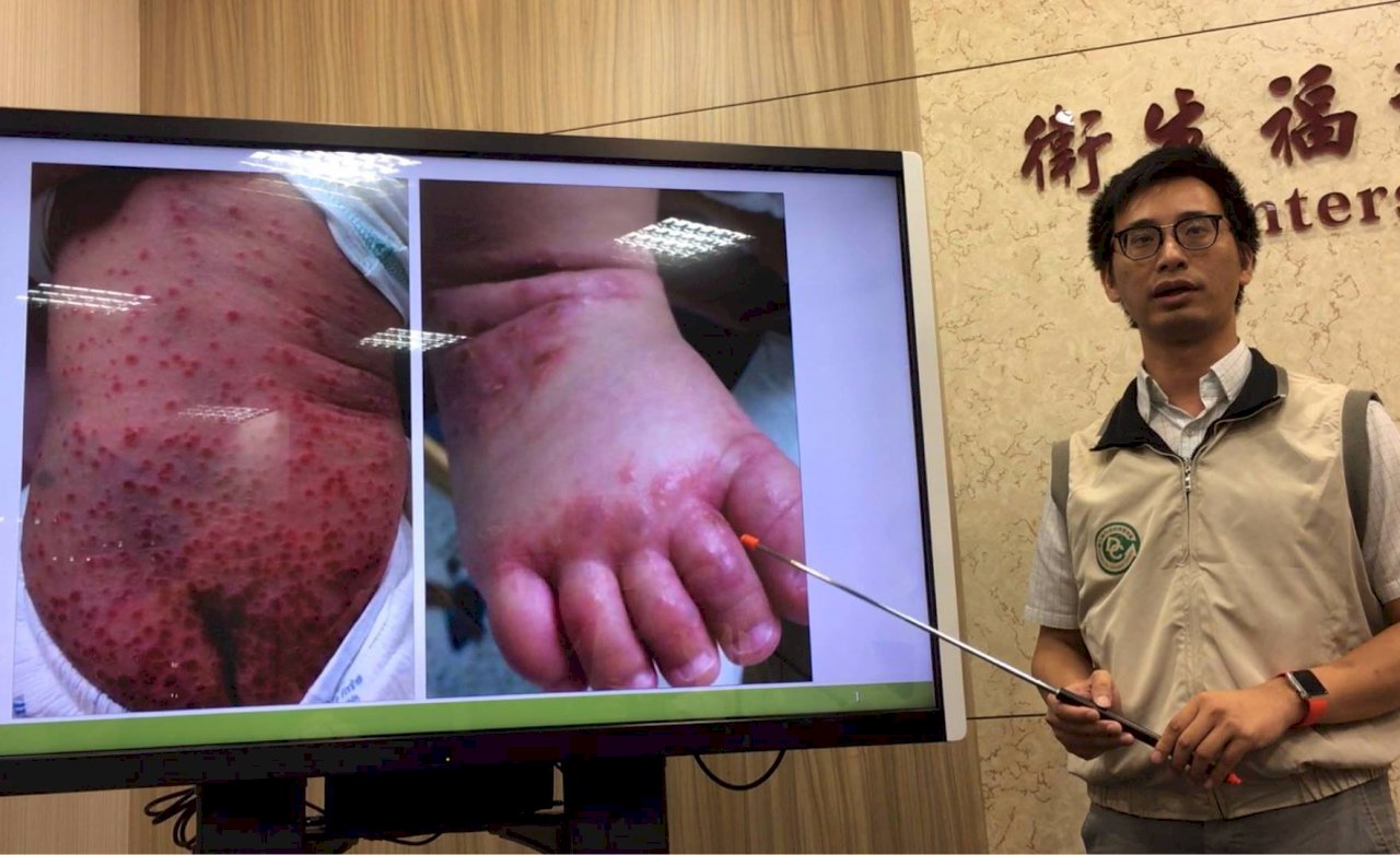 大水泡小紅疹 克沙奇A6型腸病毒嚇人