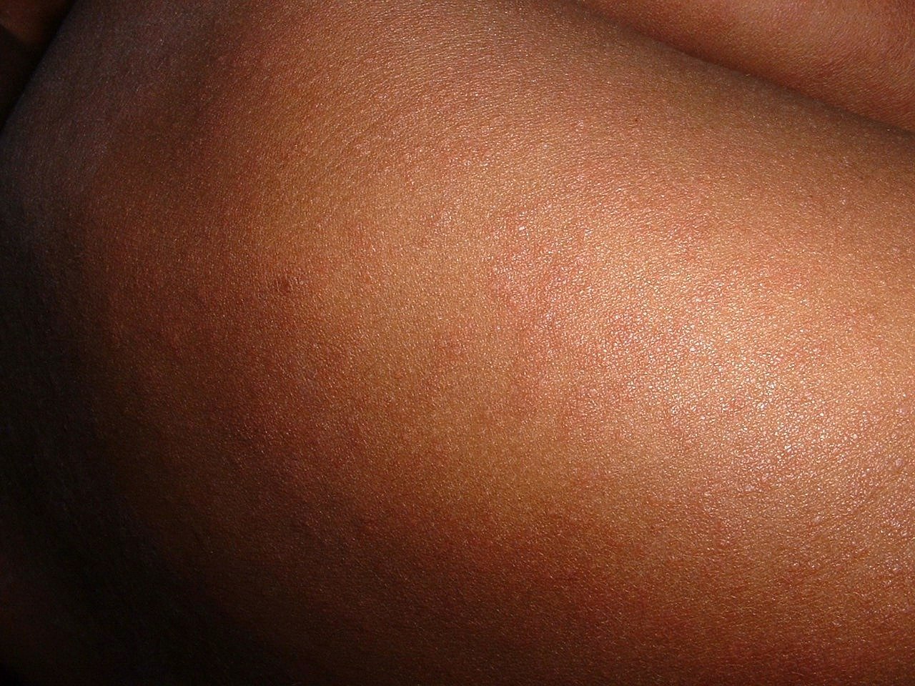 麻疹疫情蔓延 薩摩亞強制打疫苗鄰國也停課