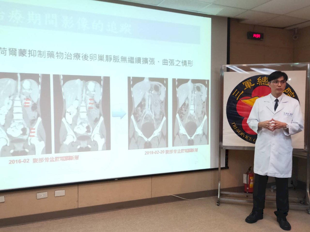 女童腹痛如生產痛 竟是全球首例性早熟合併鬱血症候群