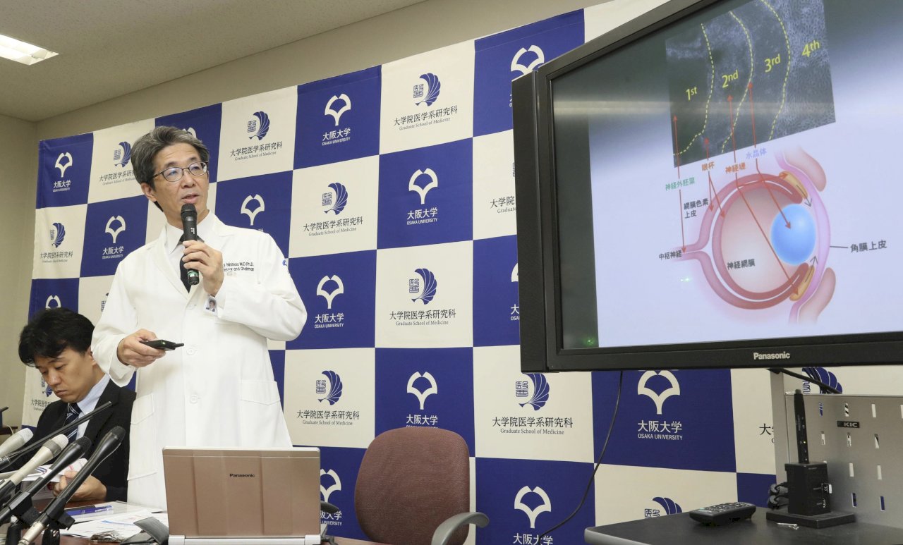 全球首例iPS細胞角膜移植 日女視力已改善
