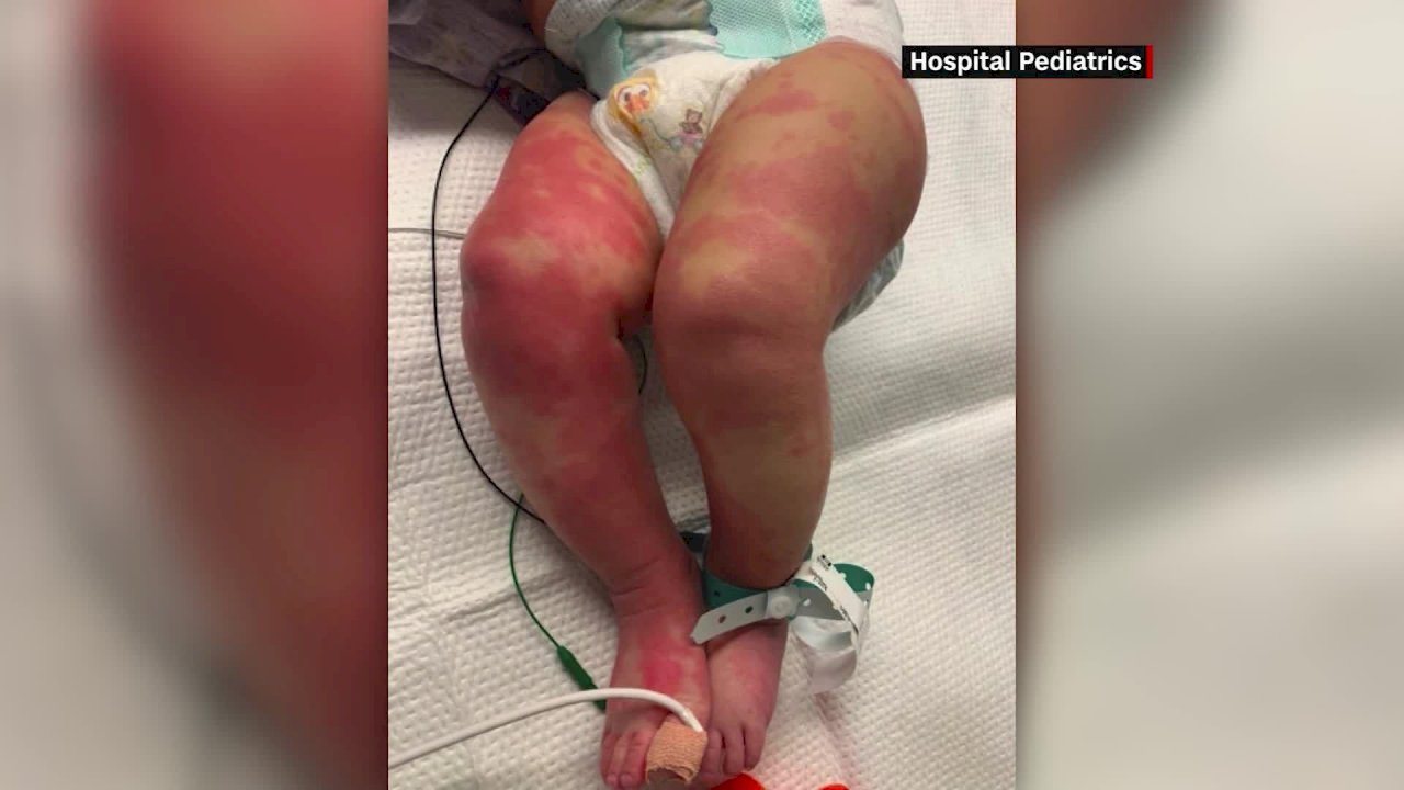 美國警告：罕見小兒致命疾病據信與冠狀病毒有關