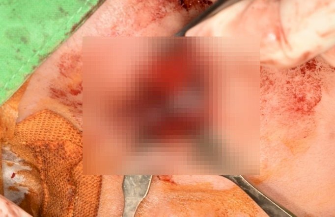 全球極罕見 三總眼眶拔牙手術創全國首例