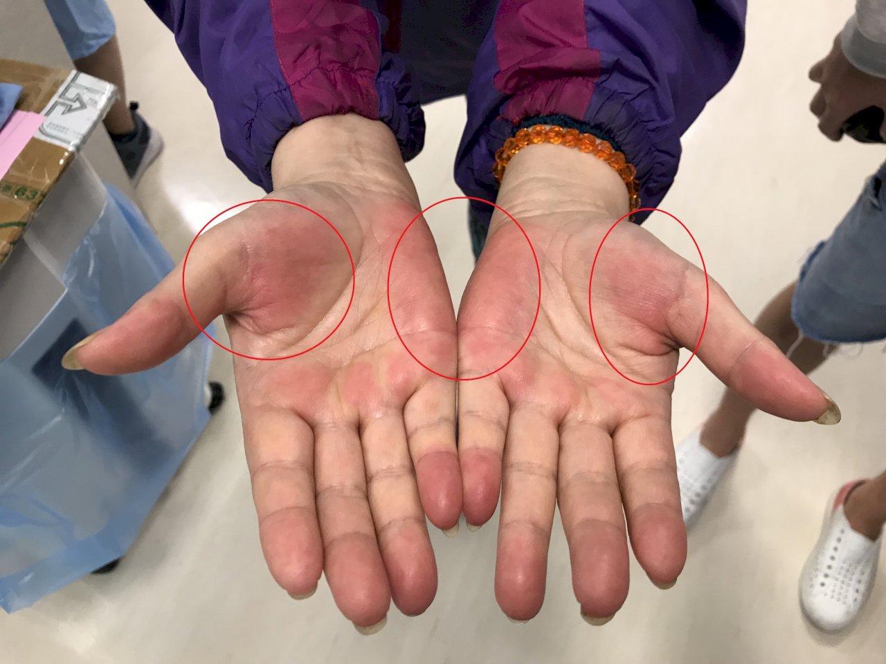 出現「肝掌」要注意  恐是肝癌前兆