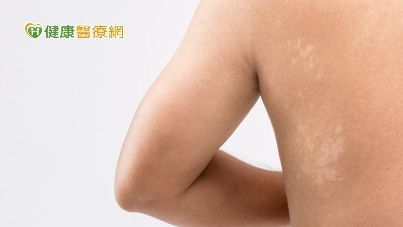夏天一到就開始長汗斑？皮膚醫解析「治療守則」