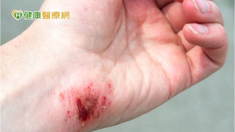 被海鮮刺傷　中年男「壞死性筋膜炎」險致命
