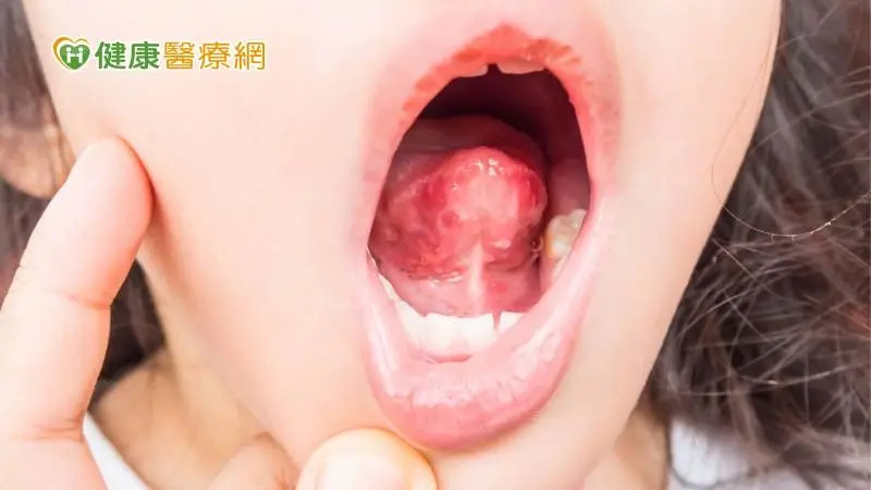 小孩腸病毒沒食慾 醫：「這些軟食物」應急