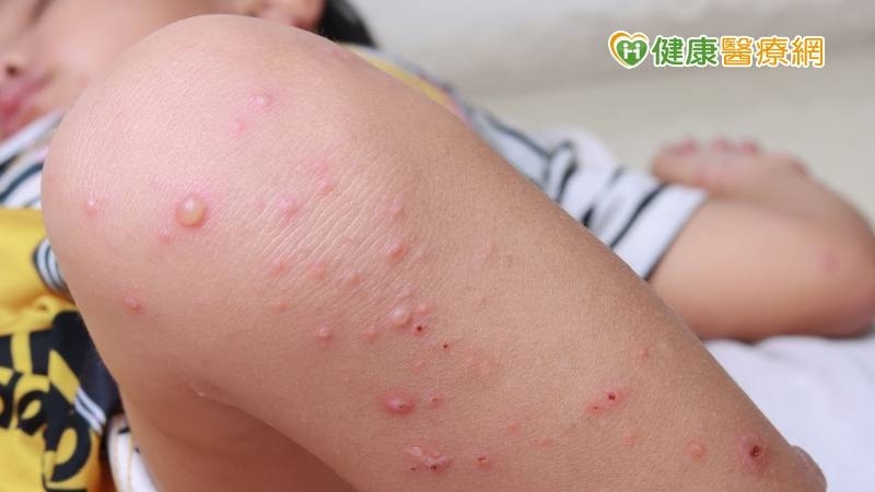 感染腸病毒無特效藥！警惕「四大重症前兆」速就醫